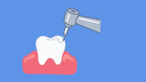 Animation tooth preparation using high speed dental bur drill Stock Footage 336650547