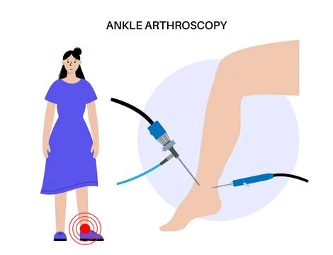 Ankle arthroscopy poster Illustrazione stock