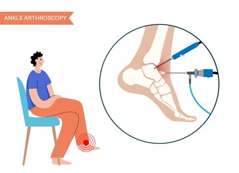 Ankle arthroscopy poster Illustrazione stock