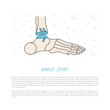 Ankle joint replacement Stock Illustration