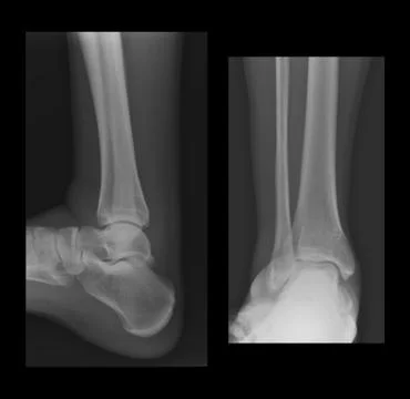 Ankle radiographs Stock Photos