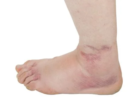 Ankle sprain Stock Photos
