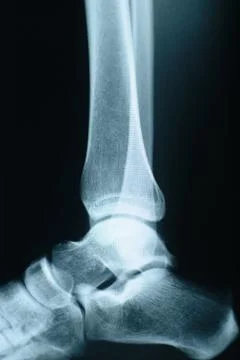 Ankle xray Foto stock