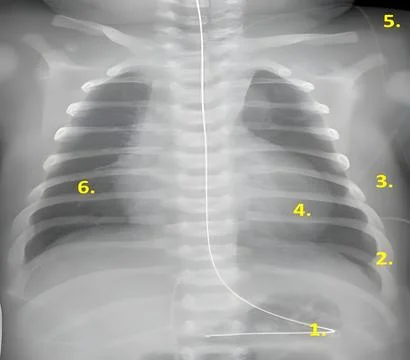 Annotated Chest X-Ray Highlighting Anatomical and Clinical Details for Diag.. Stock Photos