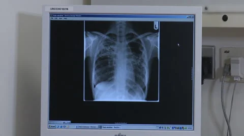 Anonymous Chest Xray MRI Scan on computer Stock Footage 47609764
