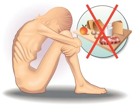 Anorexia Illustrazione stock