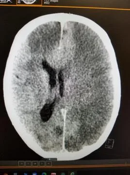 Anoxic brain damage with right shift on head CT Stock-Fotos
