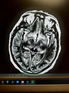 Anoxic brain damage with right shift on head MRI Stock Photos