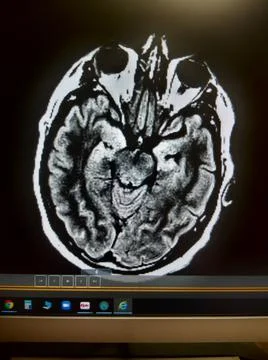 Anoxic brain damage with right shift on head MRI Stock-Fotos