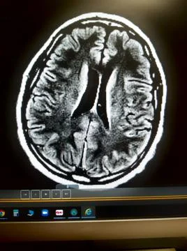 Anoxic brain damage with right shift on head MRI Stock Photos