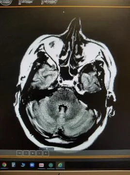 Anoxic brain damage with right shift on head MRI Stock Photos