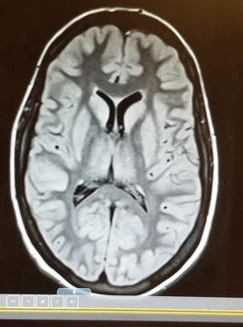 Anoxic brain damage with right shift on head MRI Stock Photos