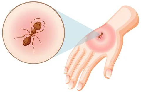 Ant bites sting on skin Stock Illustration
