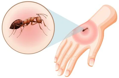 Ant bites sting on skin Stock Illustration