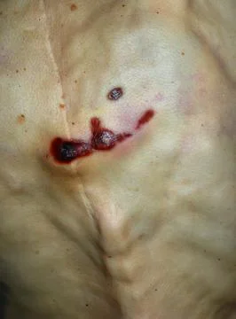 Antemortem pressure ulcers on the back of an extremely thin cadaver Stock-Fotos