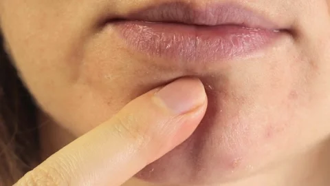 Anti acne patch Stock Footage 329237706