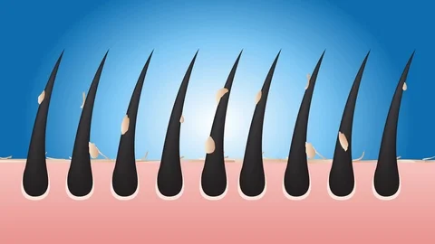 Anti Dandruff stages vector , closeup on skin and dandruff ( black hair ) Stock Footage 85969901