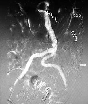 Aoritogram with mesenteric and iliac embolization coils Foto stock