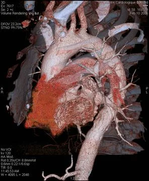  Aorta, 3d scan Angiography scanner 3D. Aorta and pulmonary vascularizatio... Stock Photos