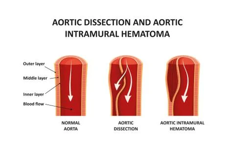 Aortic dissection and aortic intramural hematoma Stock Illustration
