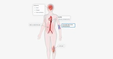 Aortitis is a rare condition characterized by inflammation of the aorta. Stock Illustration