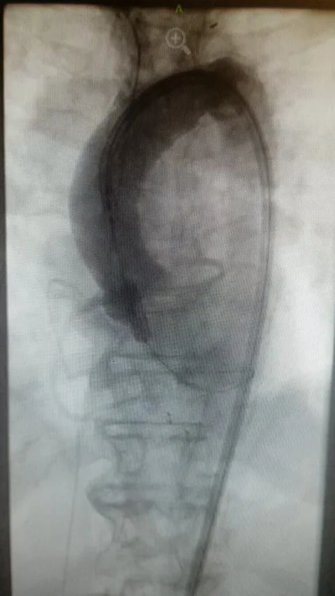 Aortogram - TAVR insertion angiography HD video Stock Footage 169969810