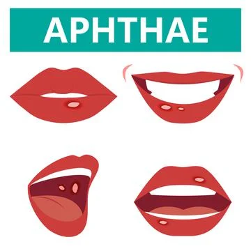 Aphthous ulcers on mouth close up,, vector illustration cartoon flat design clip Stock Illustration