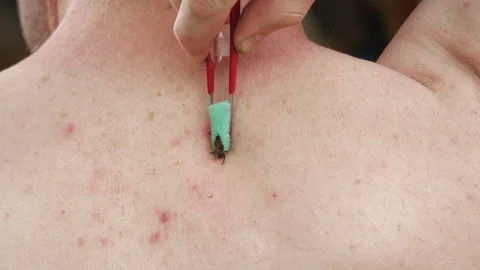 Apitherapy. With the help of tweezers, the bee is placed on the skin of a person Stock Footage 244296722