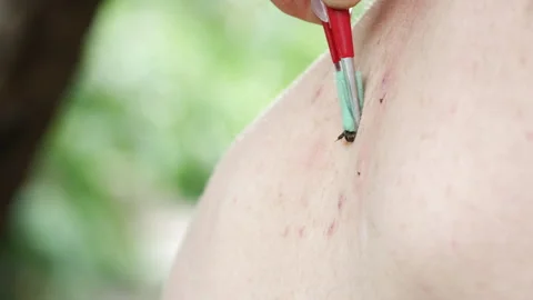 Apitherapy. With the help of tweezers, the bee is placed on the skin of a person Stock Footage 245301402
