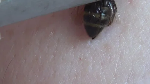 Apitherapy. With the help of tweezers, the bee is placed on the skin of a person Video stock 252288988