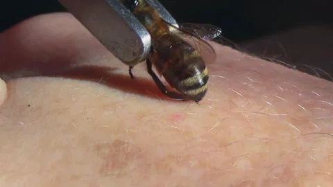 Apitherapy. With the help of tweezers, the bee is placed on the skin of a person Stock Footage 252587135