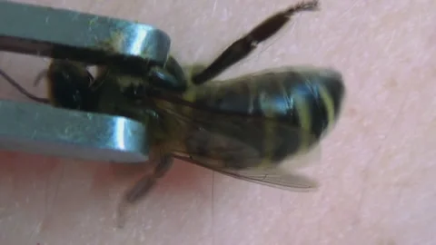 Apitherapy. With the help of tweezers, the bee is placed on the skin of a person Stock-Footage 253160295