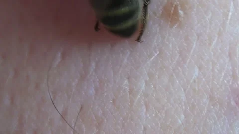 Apitherapy. With the help of tweezers, the bee is placed on the skin of a person Stock-Footage 254951662
