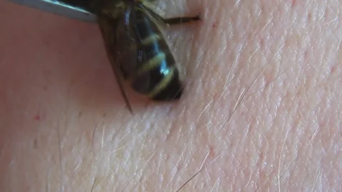 Apitherapy. With the help of tweezers, the bee is placed on the skin of a person Stock-Footage 255123014