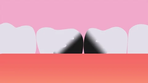 The appearance of caries on teeth. Animation 2D Stock-Footage 308035791