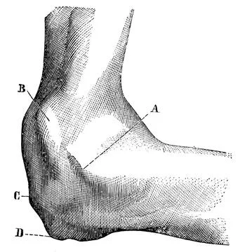 Appearance of the dislocated elbow joint. Illustration of the 19th century... Foto stock