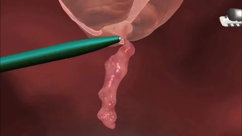 Appendectomy Stock Footage 269203670
