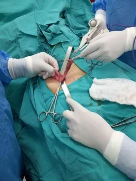 Appendectomy Procedure for Appendicitis 1 Stock Photos