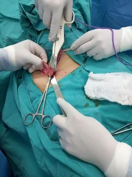 Appendectomy Procedure for Appendicitis 3 Stock Photos