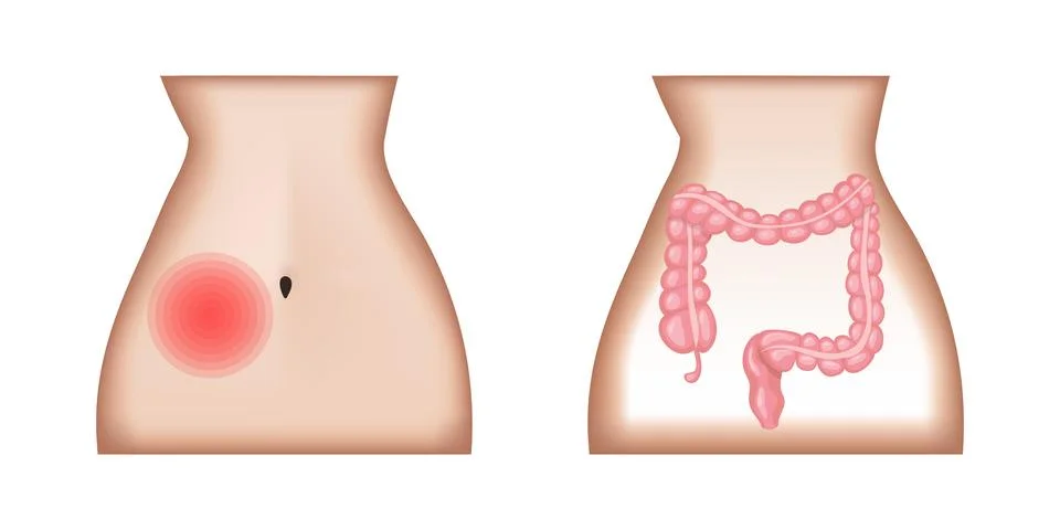 Appendicitis causing lower right abdominal quadrant pain and inflamed appendix Stock Illustration