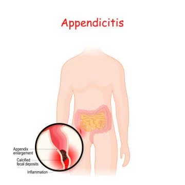 Appendicitis. closeup of appendix with Inflammation. Stock Illustration