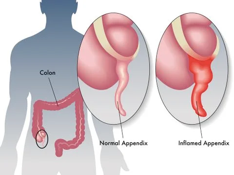 Appendicitis Stock Illustration