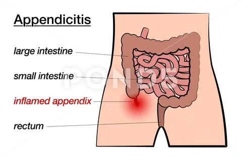 Appendicitis Inflamed Appendix Labeled Chart Stock Illustration