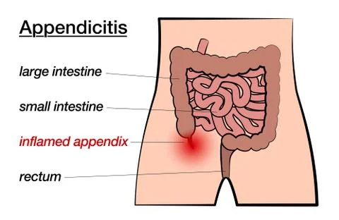 Appendicitis Inflamed Appendix Labeled Chart 스톡 일러스트