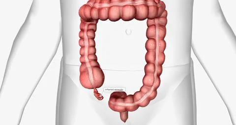 Appendicitis is the inflammation of the appendix, a thin, tube-like organ a.. Stock Illustration