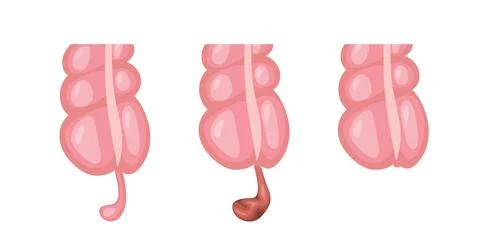 Appendicitis inflammation developing stages, normal and infected appendix Stock Illustration