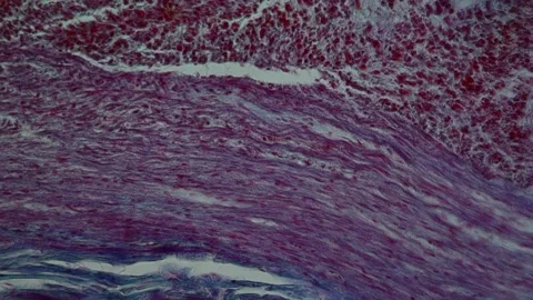 Appendicitis inflammation diseased tissue Vidéo 342830457