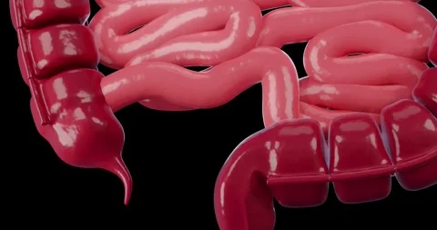 Appendicitis, large intestine, digestive system 4K Stock Footage 282426457