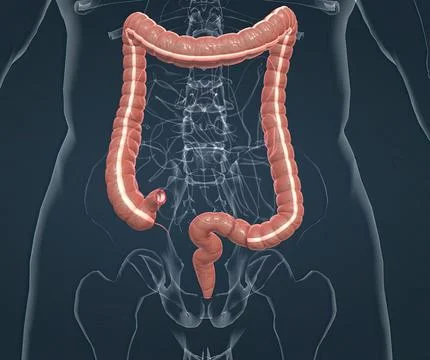 Appendicitis is a painful swelling of the appendix. Stock Illustration