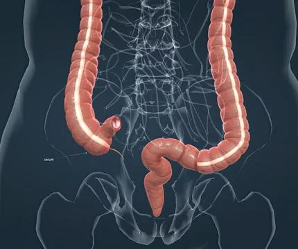 Appendicitis is a painful swelling of the appendix. 스톡 일러스트